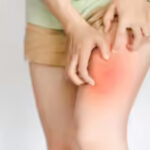 How to Heal Chafing Overnight