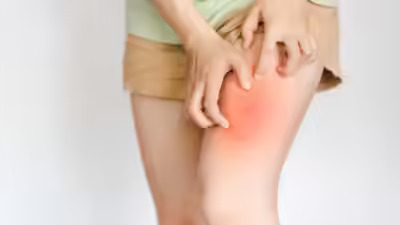 How to Heal Chafing Overnight