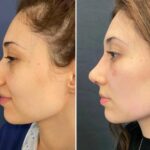 Fat Grafting in Dubai – Natural Enhancement Without Implants