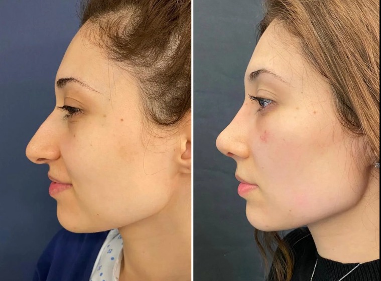 Fat Grafting in Dubai – Natural Enhancement Without Implants