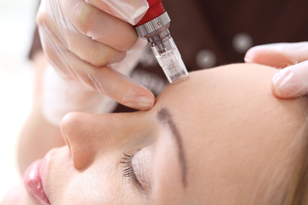 Microneedling in Beverly Hills: The Secret to Flawless, Youthful Skin