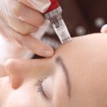Microneedling in Beverly Hills: The Secret to Flawless, Youthful Skin
