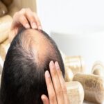 Hair Loss Treatment in Riyadh 1