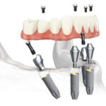 All-on-4 Implants Aberdeen
