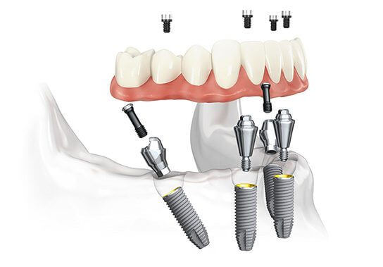 All-on-4 Implants Aberdeen
