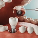Single Implants Aberdeen